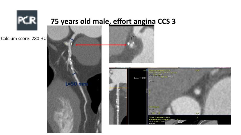 Left Main And Complex Bifurcation Stenting