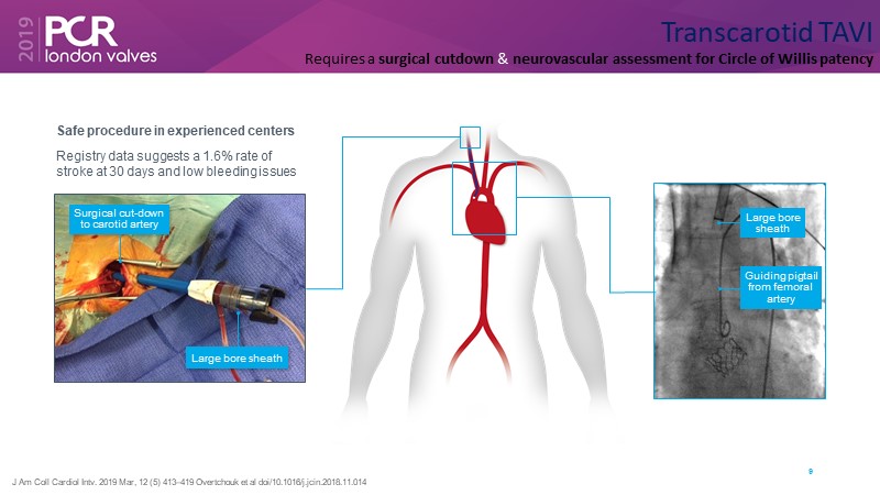 Transfemoral Tavi Access Using Intravascular Lithotripsy In Patients