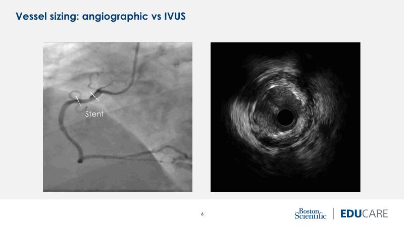 The importance of IVUS in optimising PCI of the left main coronary artery