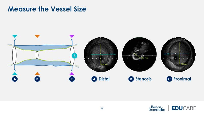 The importance of IVUS in optimising PCI of the left main coronary artery