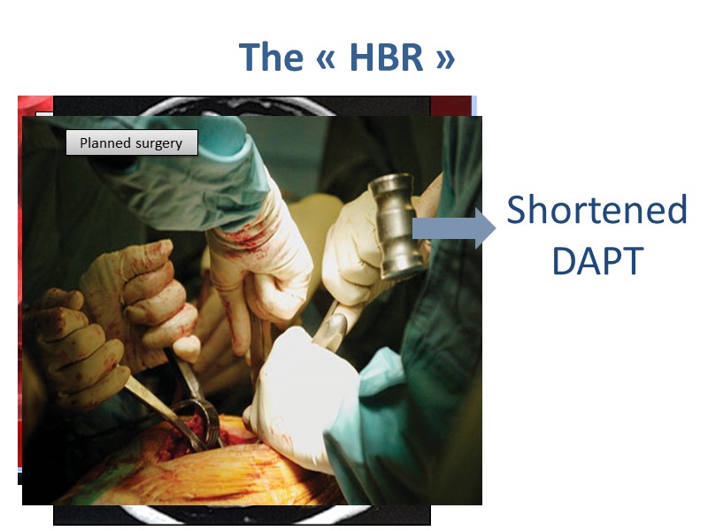 High Bleeding Risk Patients: From Clinical Evidence To Routine Practice