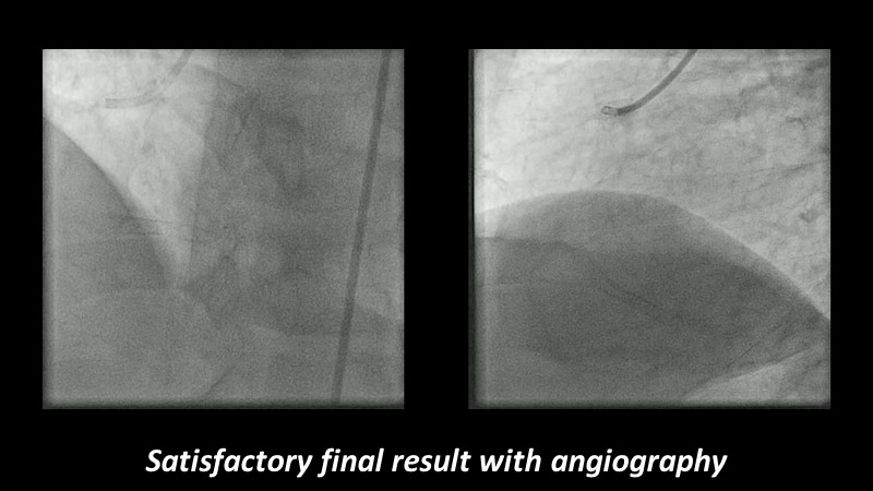 Go Implant-free In De Novo Lesions: DCB-only Strategy