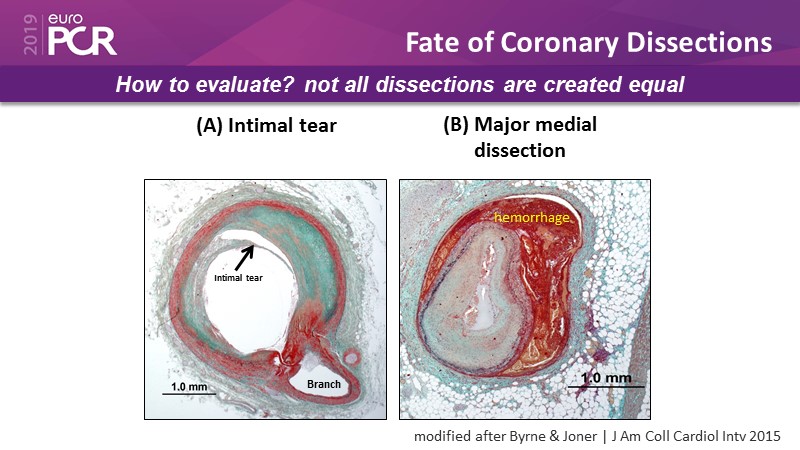 Go Implant-free In De Novo Lesions: DCB-only Strategy