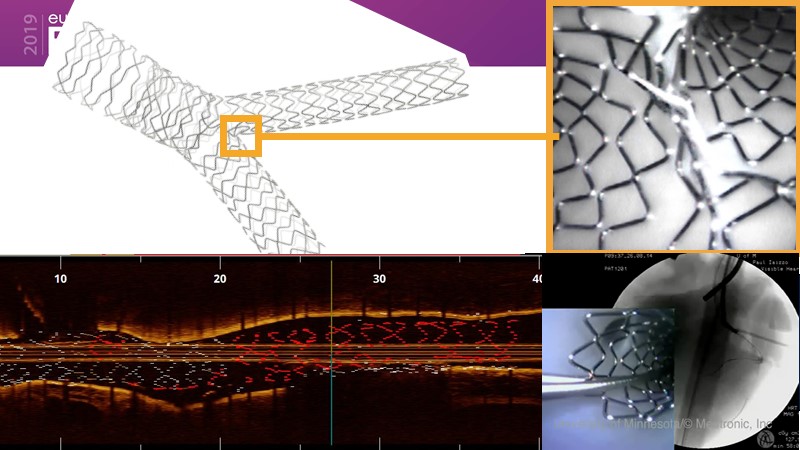 Left Main Bifurcation Stenting: A Case-based Approach