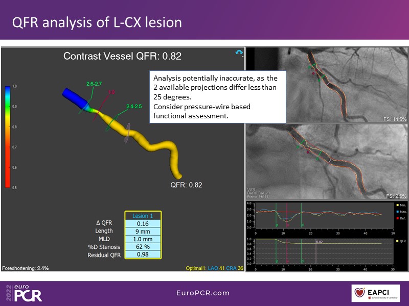 How to select three-vessel disease patients eligible for PCI and guide ...