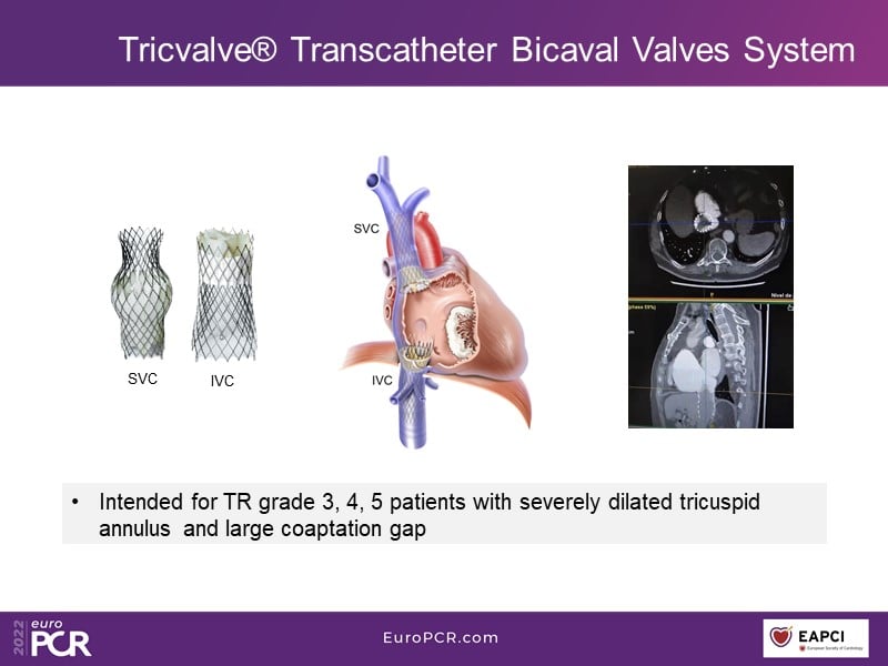 TricValve - Addressing the unmet need for patients with right heart ...