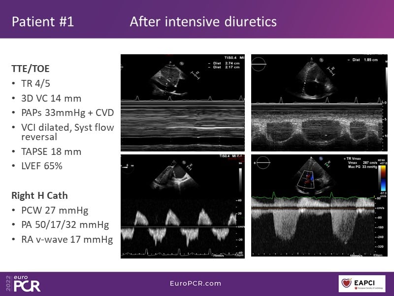 TricValve - Addressing the unmet need for patients with right heart ...