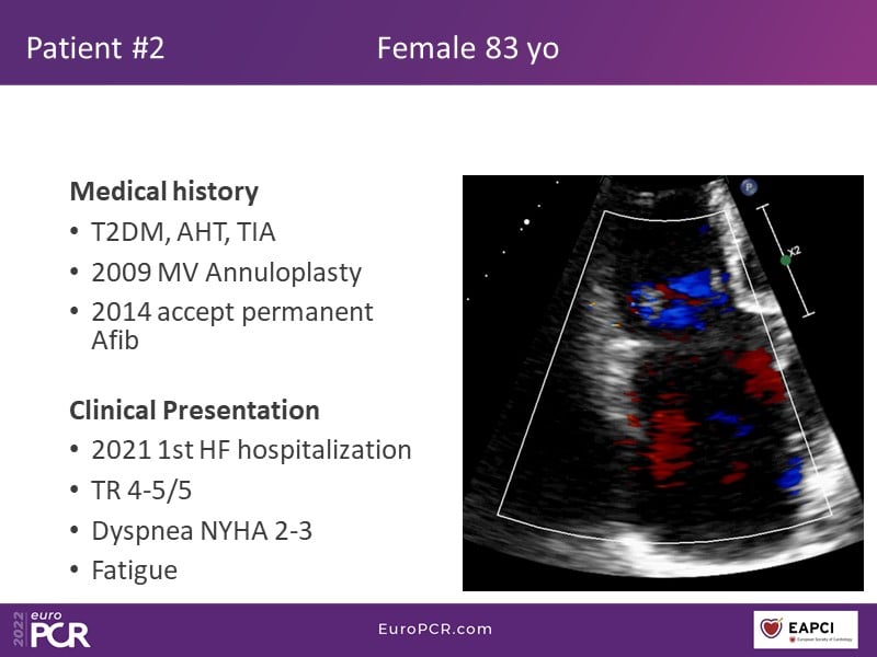 TricValve - Addressing the unmet need for patients with right heart ...