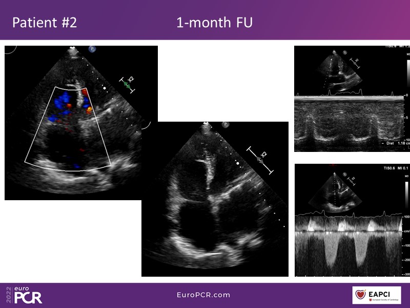 TricValve - Addressing the unmet need for patients with right heart ...