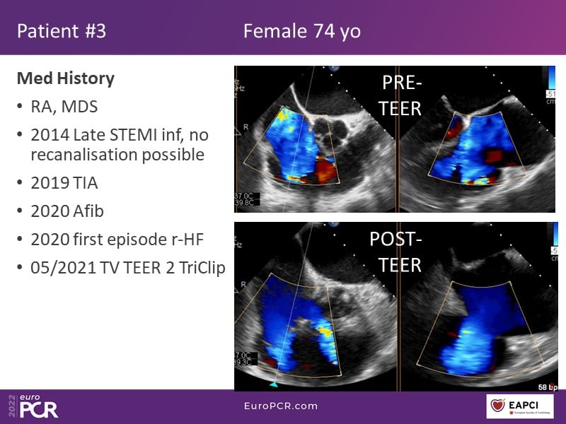 TricValve - Addressing the unmet need for patients with right heart ...