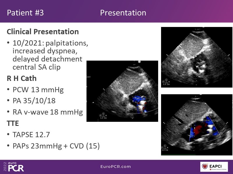 TricValve - Addressing the unmet need for patients with right heart ...