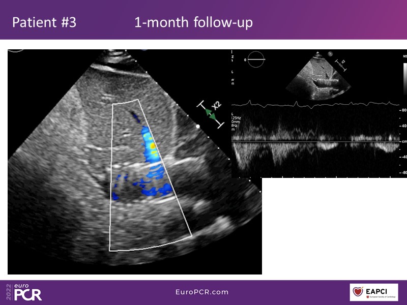 TricValve - Addressing the unmet need for patients with right heart ...