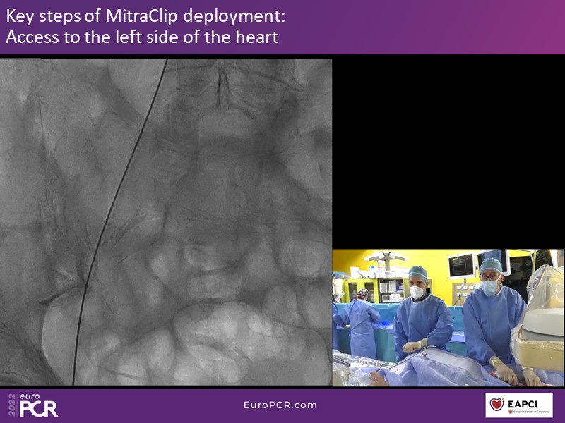 From Access To Closure In Transcatheter Valve Procedures - Optimising ...