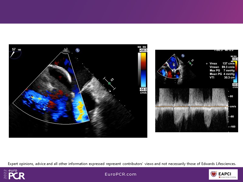 2022: a tipping point in the treatment of mitral regurgitation patients