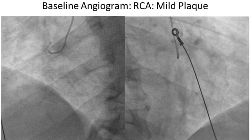 Redefining Indications For Drug-eluting Balloons In Complex Pci - The 