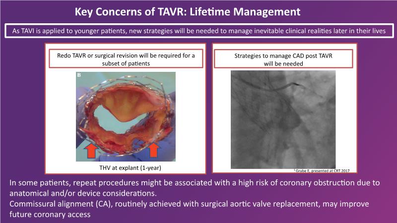 Next Generation Balloon Expandable Tavr And Thin Strut Brs - Science 