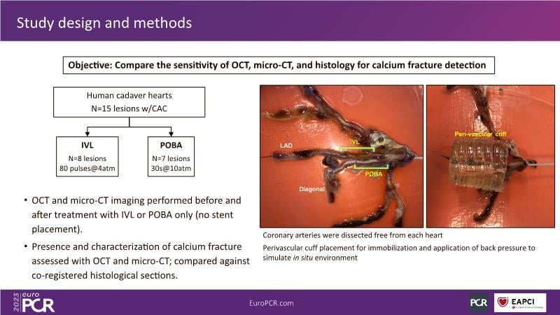 Intravascular lithotripsy in the real world: the revolution continues