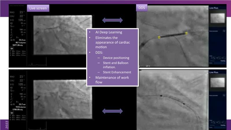 Meaningful Innovations In Interventional Cardiology