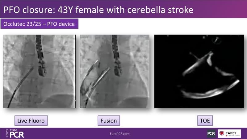 Meaningful Innovations In Interventional Cardiology