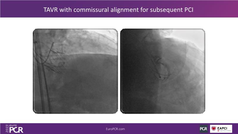 The next generation DES technology: innovative DES+DCB stent platform