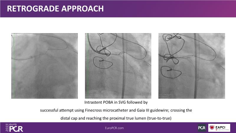 Going down the road of coronary artery disease treatment: sirolimus ...