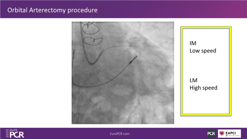 Orbital atherectomy, a versatile tool in managing complex scenarios of ...