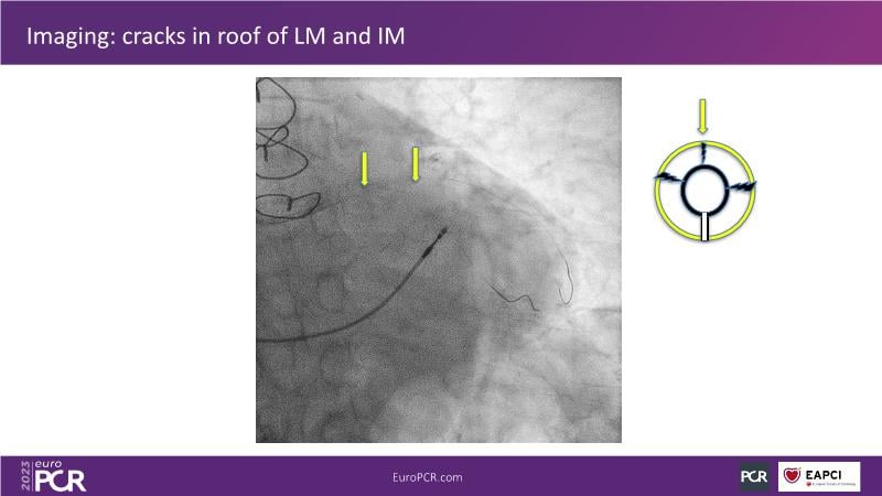 Orbital atherectomy, a versatile tool in managing complex scenarios of ...