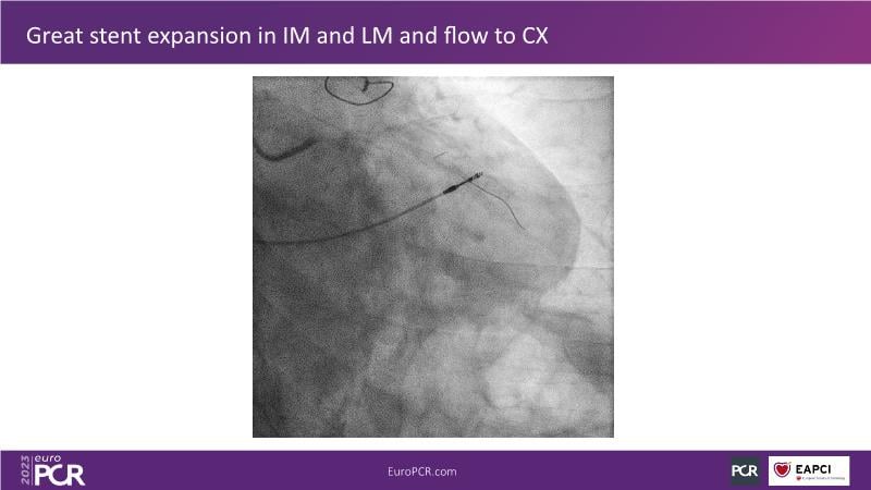 Orbital atherectomy, a versatile tool in managing complex scenarios of ...