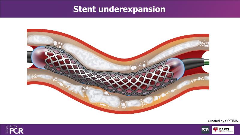 3DStent: a new era in stent enhancement