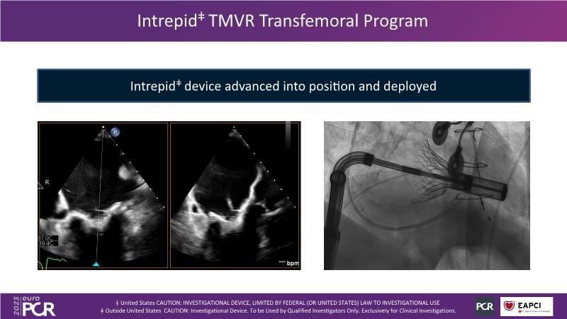 Innovations in TMVR and Intrepid trial updates