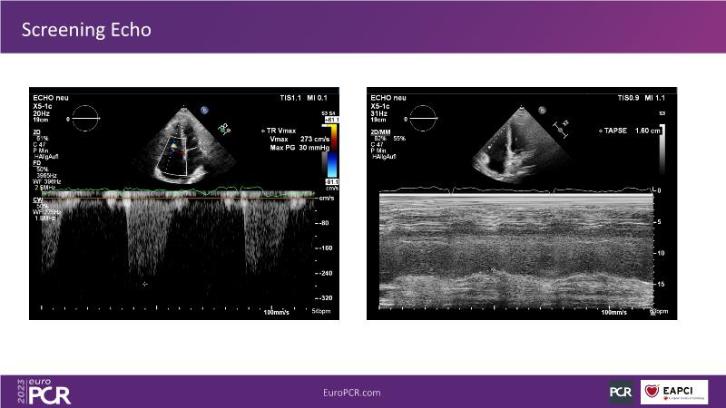 Heterotopic valve replacement for patients with right heart failure and ...