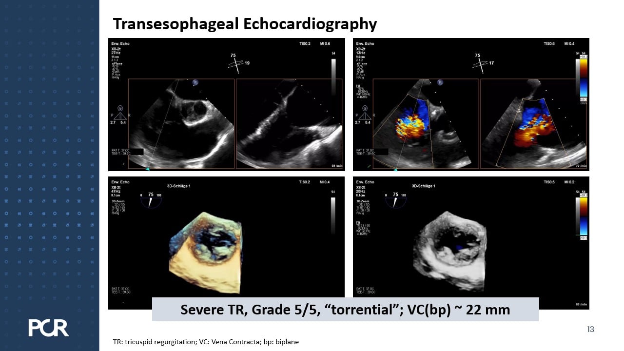 Elevating quality of heart valve treatment through innovation: SAPIEN 3 ...