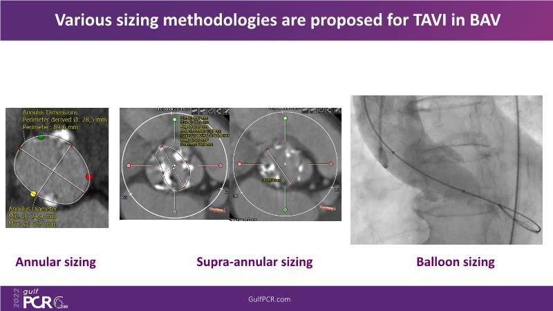 Imaging in TAVI with challenging anatomy