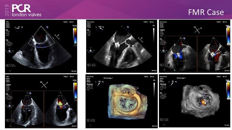 The Edwards PASCAL transcatheter valve repair system - Latest ...