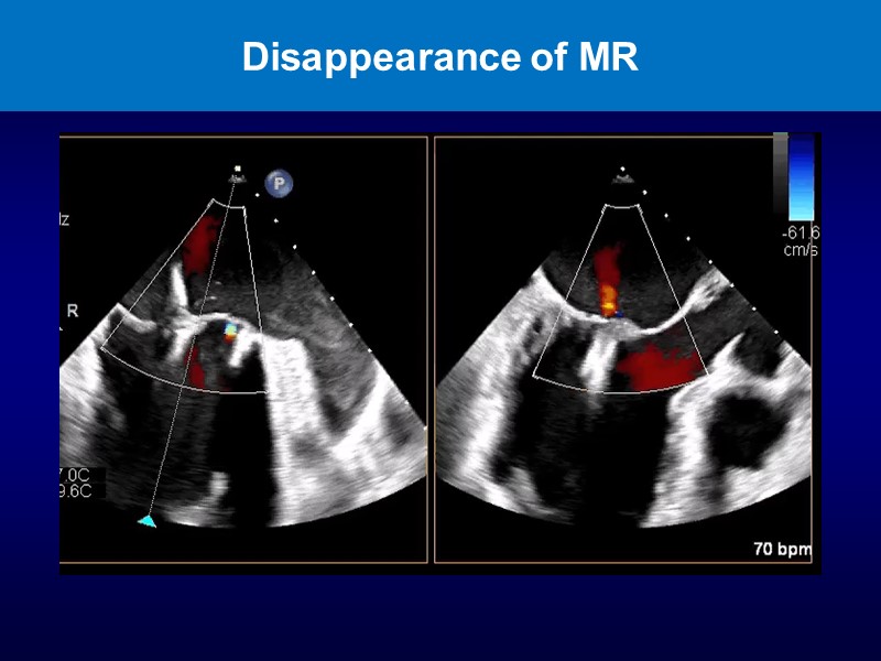 Mitral and tricuspid transcatheter valves therapies: time to innovate!