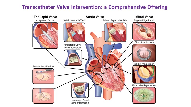 Therapy Of Valvular Heart Diseases: A Patient-centred Innovation Journey