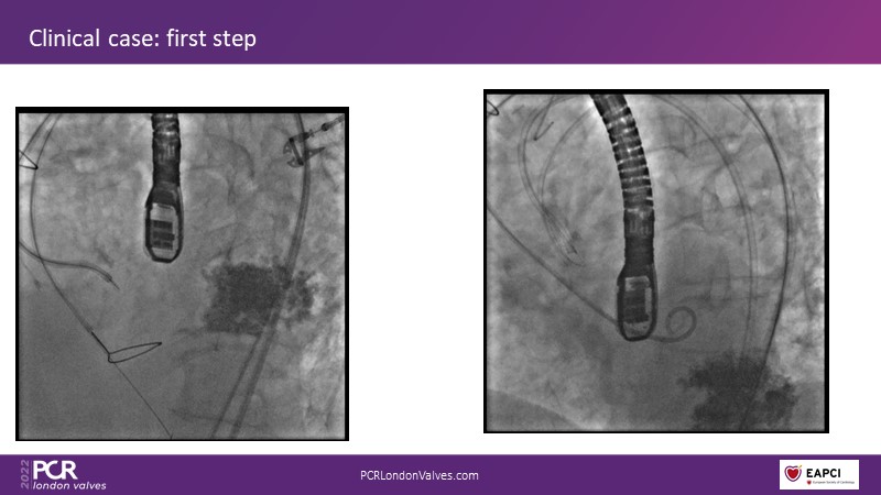 Technical challenges and optimal device choice for complex TAVI procedures