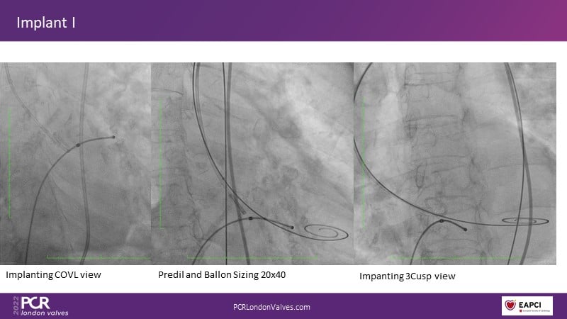 The VitaFlow TAVI system - A new device that delivers exceptional ...