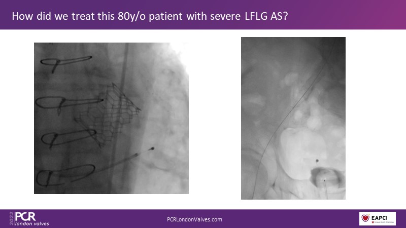 Transfemoral Tavi Access Using Intravascular Lithotripsy In Patients