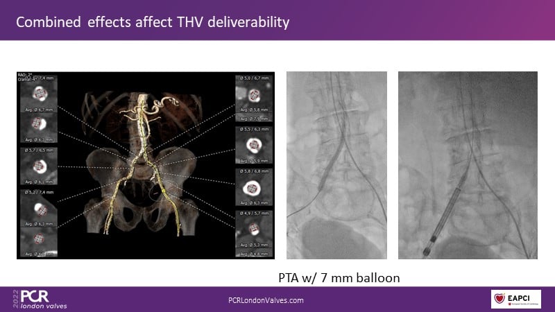 Transfemoral Tavi Access Using Intravascular Lithotripsy In Patients