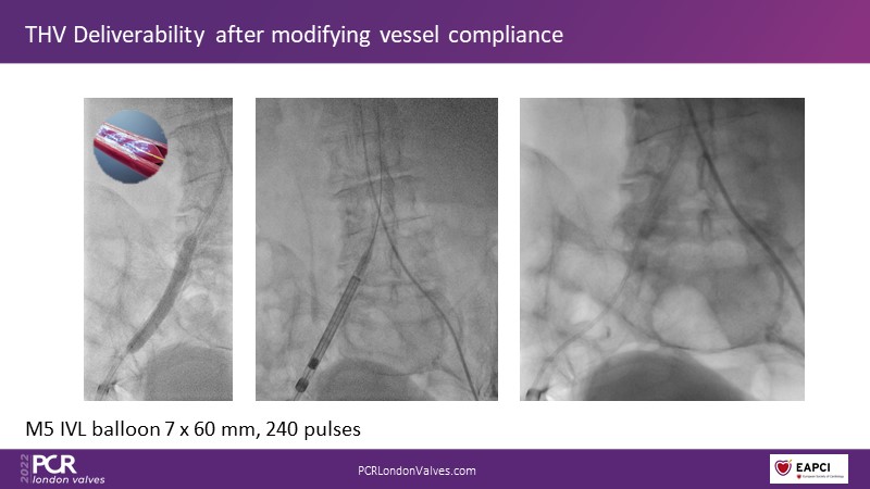 Transfemoral Tavi Access Using Intravascular Lithotripsy In Patients