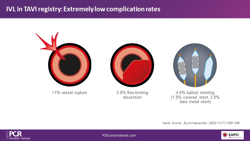 Transfemoral TAVI access using intravascular lithotripsy in patients ...