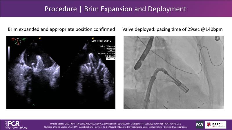 An intrepid solution for transfemoral treatment of mitral regurgitation