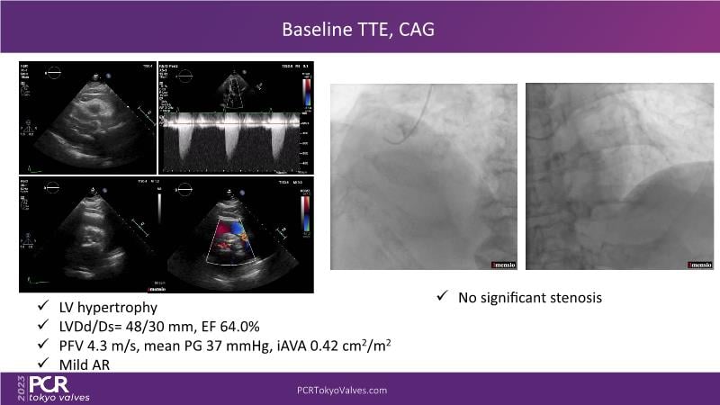 The optimal first valve choice for all patients with aortic stenosis